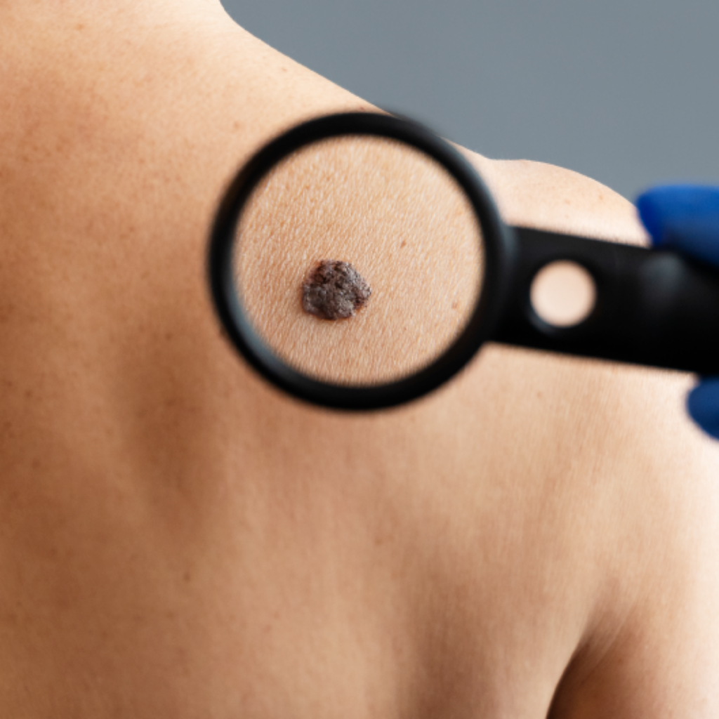 melanoma-deteccion