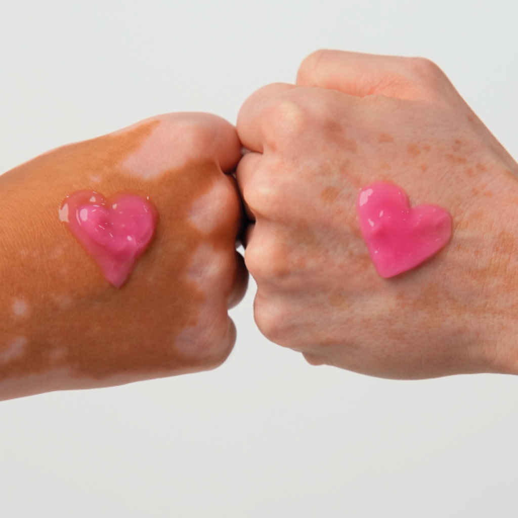 dia-mundial-vitiligo